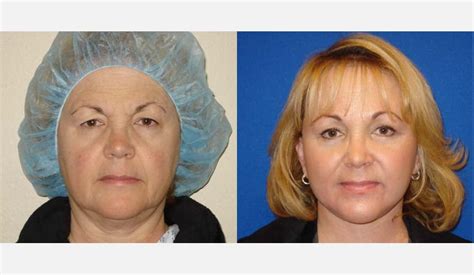 ritidoplastia antes e depois